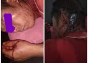Warga Desa Hilisaloo Amandraya Berhasil Lolos Setelah Dibacok.