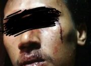 Korban Harapkan Pelaku Penganiaya Terhadap Dirinya Segera Ditangkap